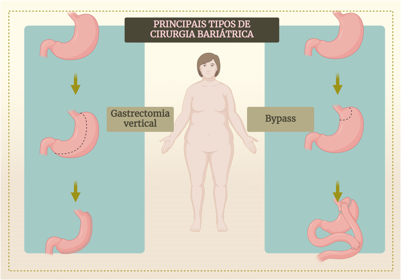 Descubra Os Principais Tipos De Cirurgia Bari Trica E Seus Benef Cios