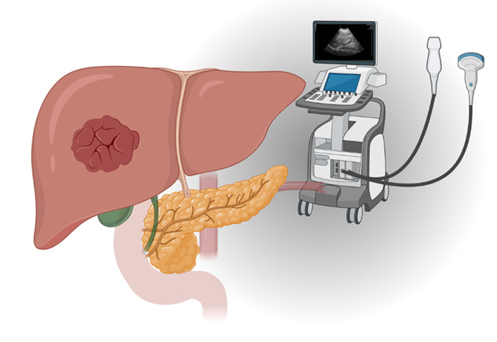 Imagem ilustra o desenho de um fígado e um aparelho de ultrassom ao lado.