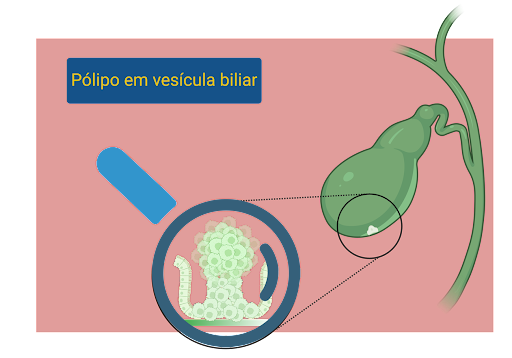 O que são pólipos na vesícula?