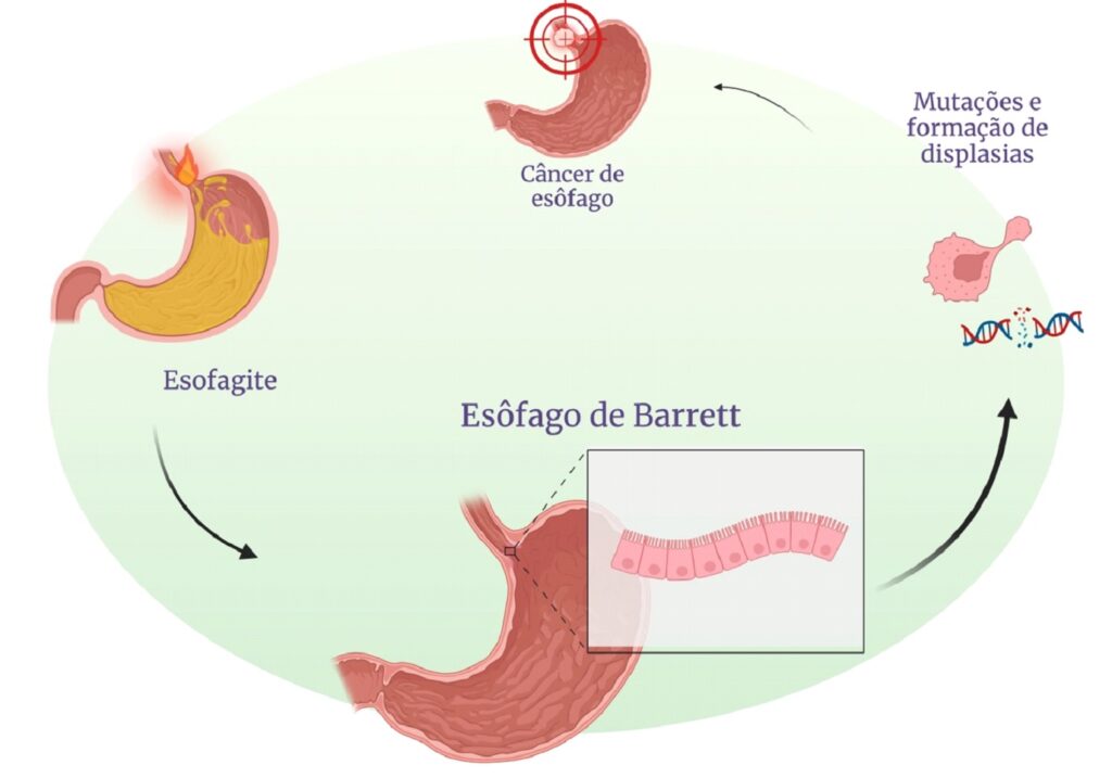 esofago de barrett o alerta silencioso para o cancer de esofago TUSTUMI