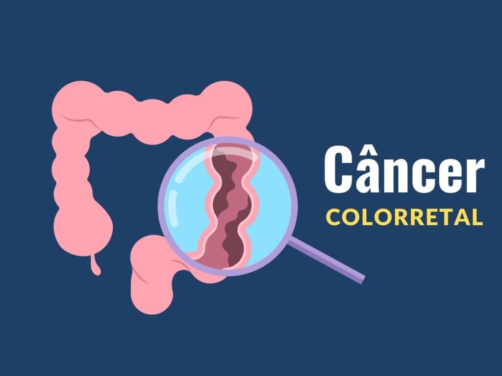 cancer colorretal no brasil crescimento alarmante e aumento na mortalidade blog