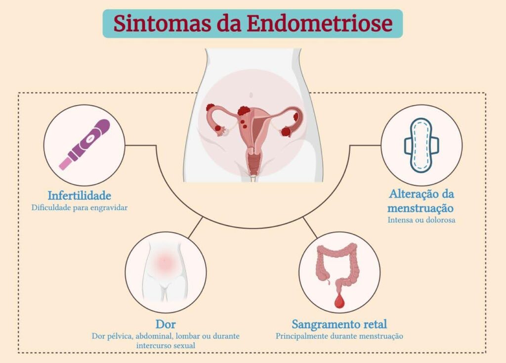 tudo o que voce precisa saber sobre endometriose blog