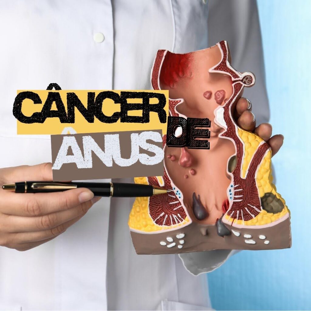 Câncer de Ânus Pode Ser Transmissível? Entenda a Relação com o HPV, Fatores de Risco, Diagnóstico e Tratamento